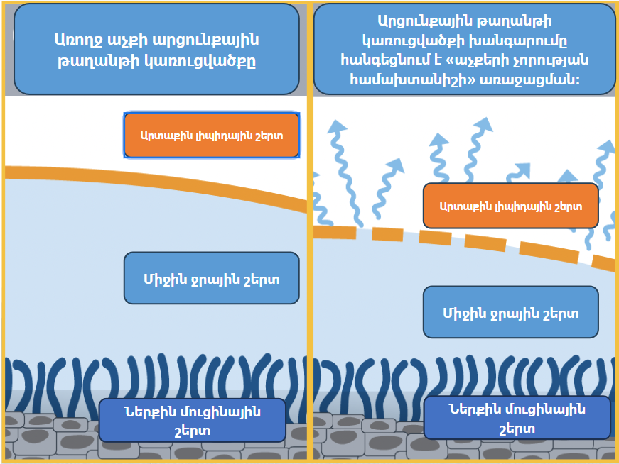 Симптомы синдрома «сухого глаза»